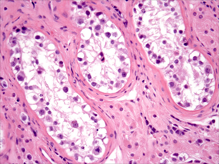 Pathology Outlines - Germ Cell Neoplasia In Situ