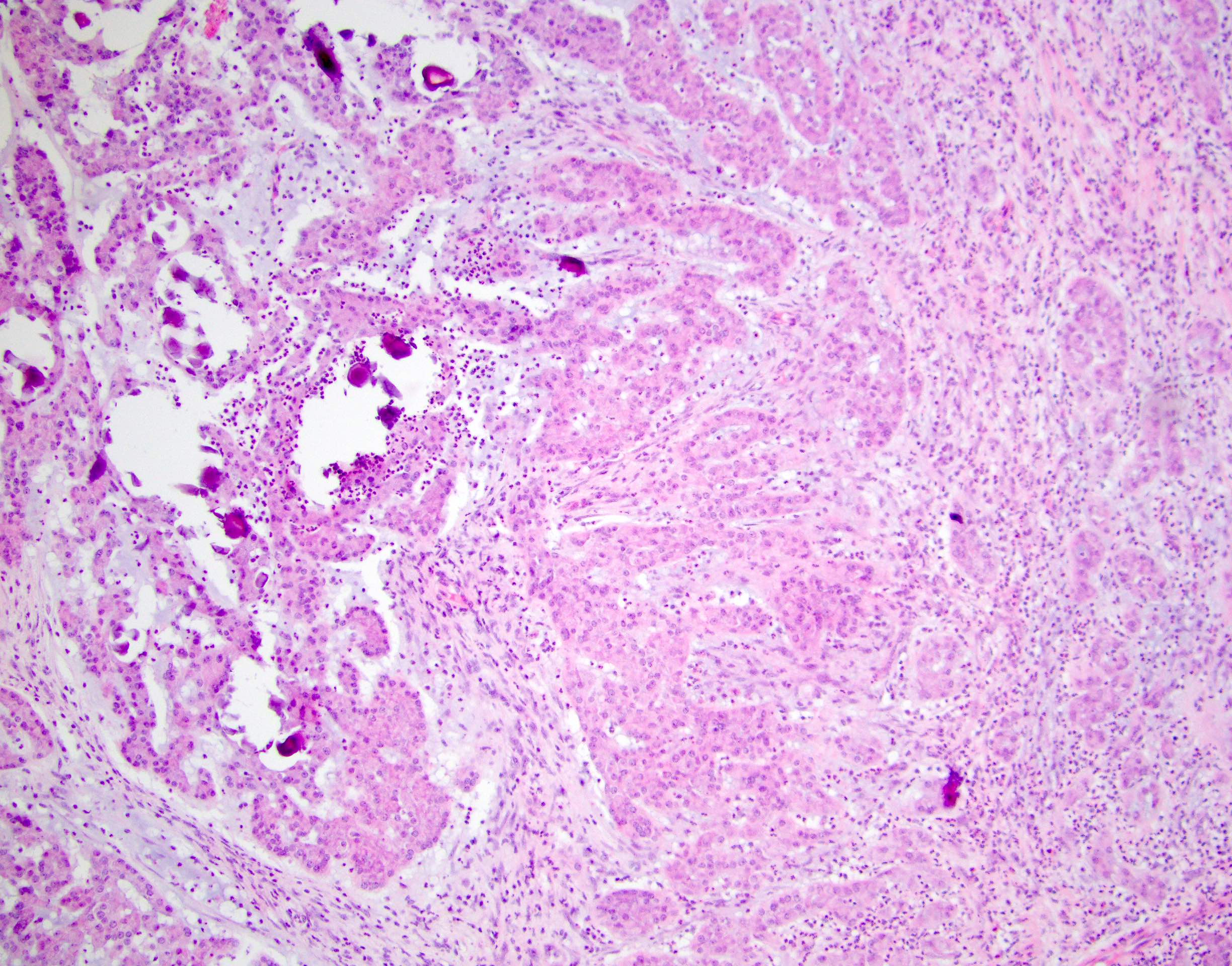 Pathology Outlines - Large cell calcifying Sertoli cell tumor