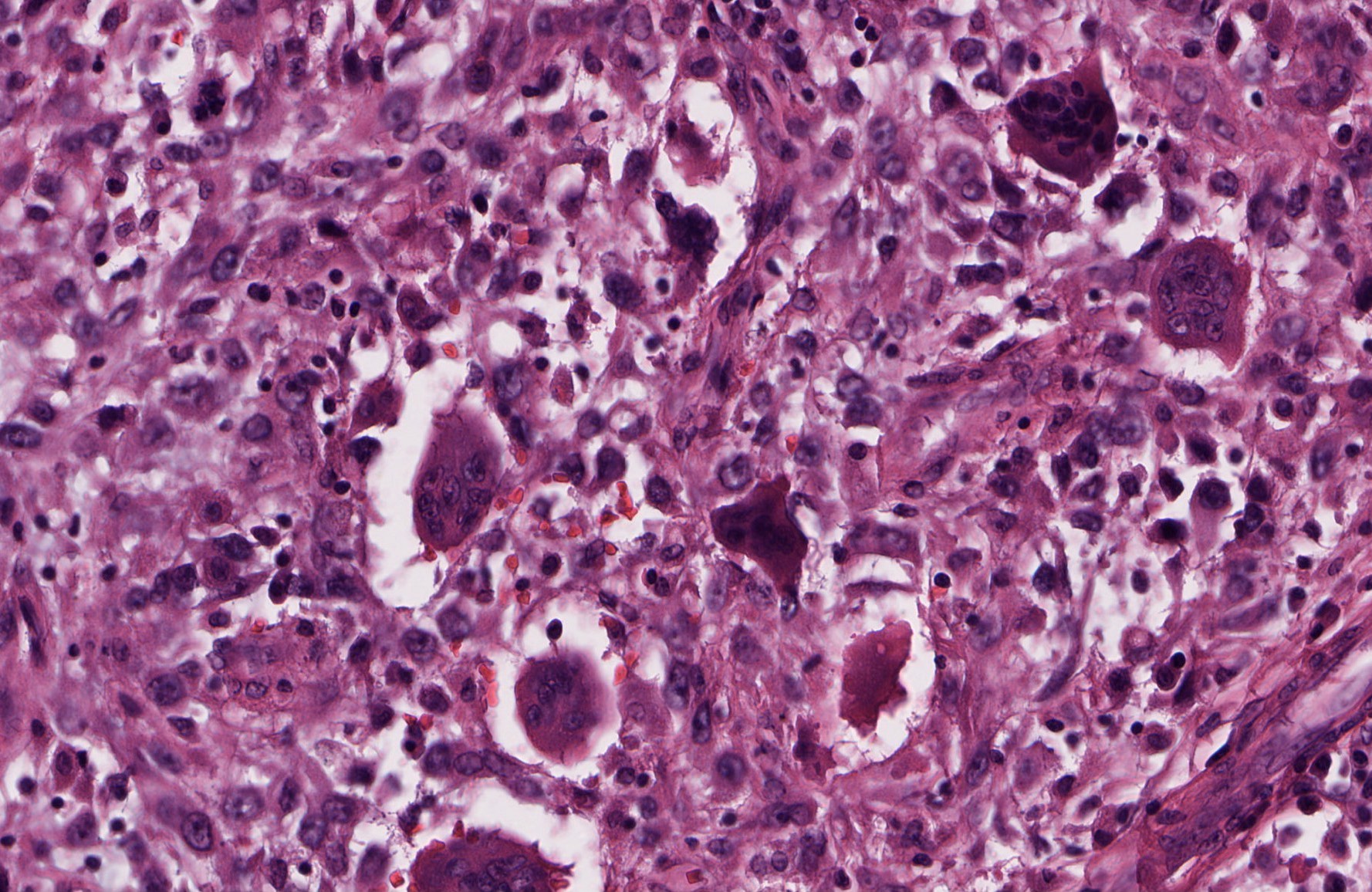 anaplastic carcinoma