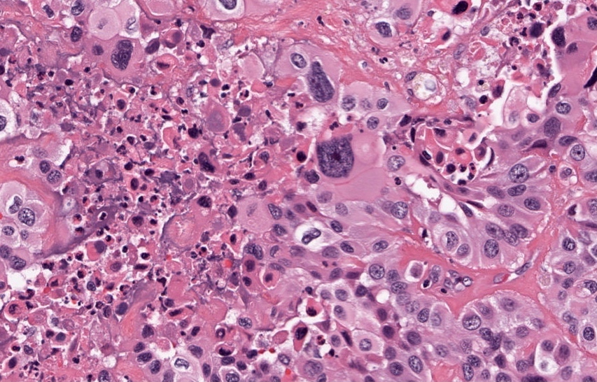 Anaplastic Carcinoma