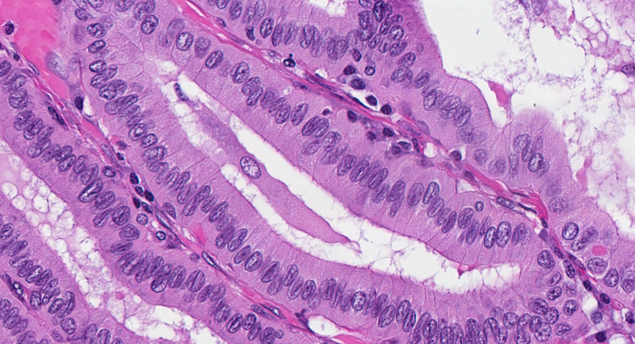 Pathology Outlines - Tall cell