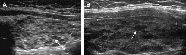 Pathology Outlines - Ultrasound