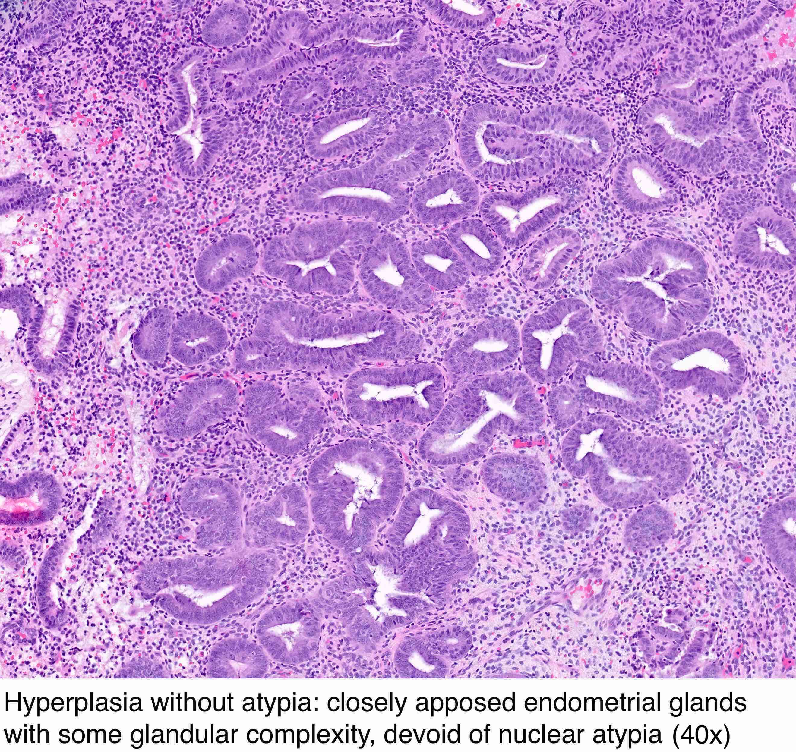 Pathology Outlines - Endometrial hyperplasia / endometrioid ...