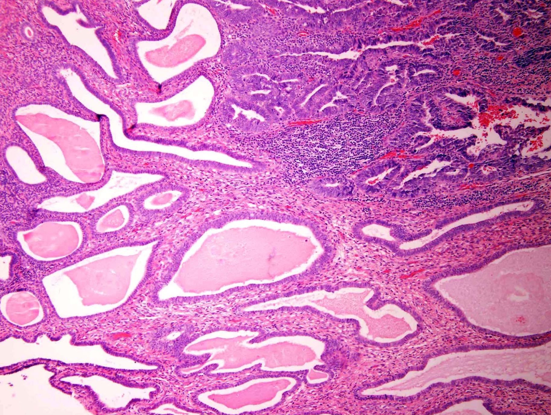 Endometrial Polyp Histology