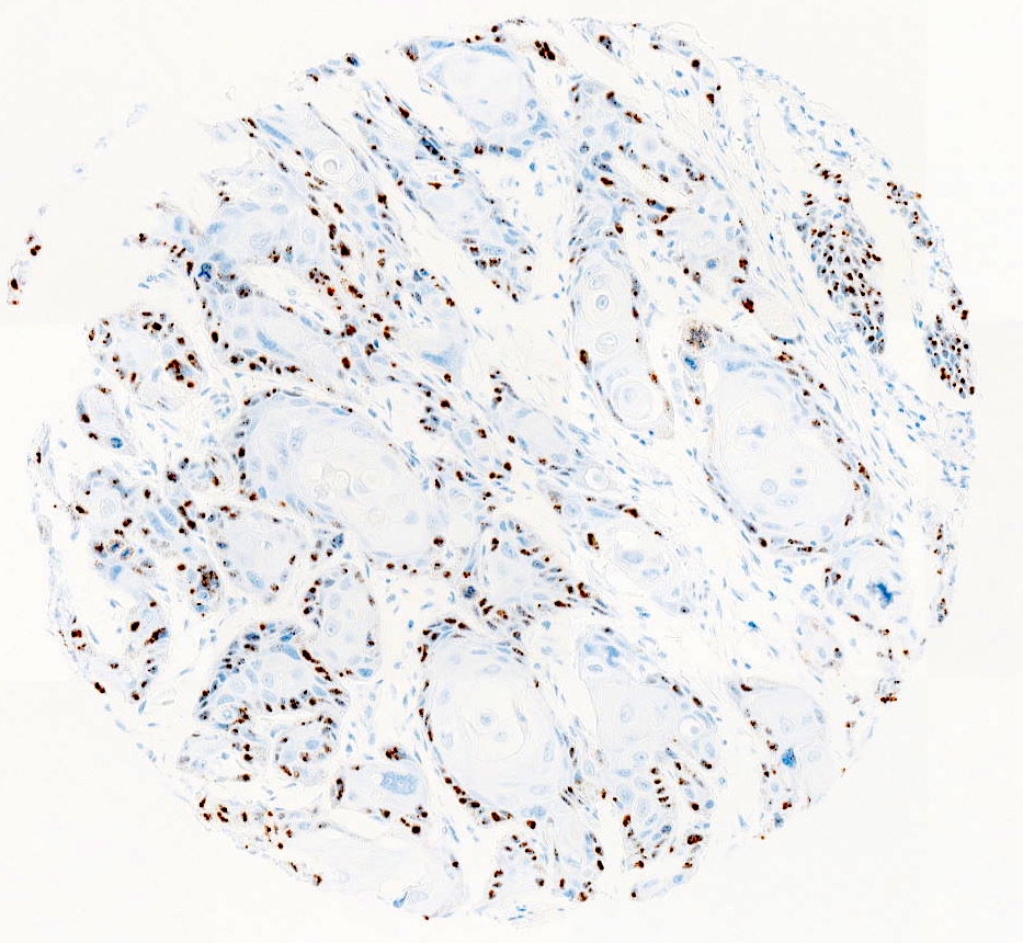 Pathology Outlines - HPV Associated Squamous Cell Carcinoma-vulva