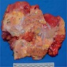 Acute pancreatitis with fat necrosis