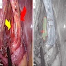 Adrenal tumor