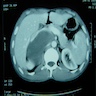 CT with contrast