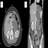 Coronal and axial CT