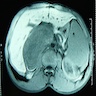 T1 weighted MRI