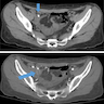 Acute appendicitis on CT