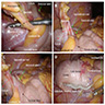 Laparoscopic appendectomy