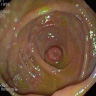 Intussuscepted appendix on colonoscopy 