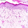 Pathology Outlines - Condyloma acuminatum