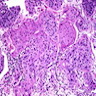 Pathology Outlines - Papillary urothelial neoplasm of low malignant ...