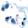 Urothelial carcinoma cytology (male urethra)