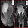 Urothelial carcinoma with extension (female urethra)