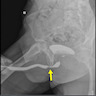 Urothelial carcinoma stricture (male patient)