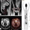 Urothelial carcinoma with metastases (female urethra)