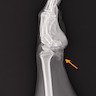 Ulnar mass