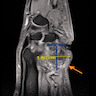 Ulnar mass, MRI