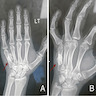 Fifth metacarpal lesion