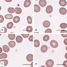 Reduced azurophilic granule content