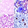 Peripheral blood smear, bone marrow aspirate smear, H&E section and CD61