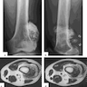 Pathology Outlines - Parosteal osteosarcoma