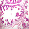 Pathology Outlines - Apocrine metaplasia of breast