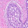 Pathology Outlines - Collagenous spherulosis