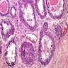 Pathology Outlines - Columnar cell lesions of breast