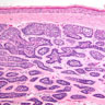 Pathology Outlines - Cylindroma