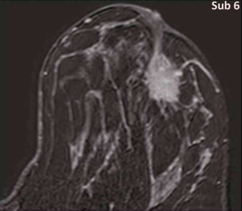 Magnetic resonance imaging