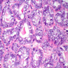 Pathology Outlines - Lactating adenoma