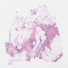 Low grade adenosquamous carcinoma and DCIS