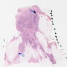 Pleomorphic lobular carcinoma