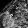 Breast calcifications