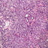 Pathology Outlines - Intraductal papilloma