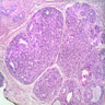 Pathology Outlines - Intraductal papilloma