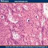 Pathology Outlines - Intraductal papilloma