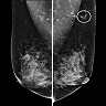 Normal appearance of accessory breast tissue on mammography