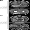 MRIs of PLAGL amplified tumors