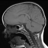 MRI of frontal mass