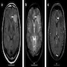 Appearance of tumor on MRI