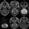 Bilateral cerebellar lesions