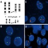 9;17 translocation; interphase FISH studies