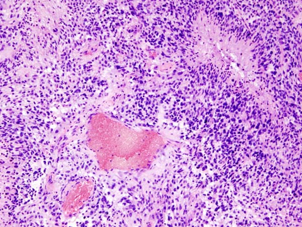 Pathology Outlines - Glioblastoma multiforme