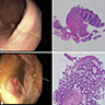 Colonoscopic findings