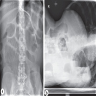 Xray showing significantly dilated small and large bowel